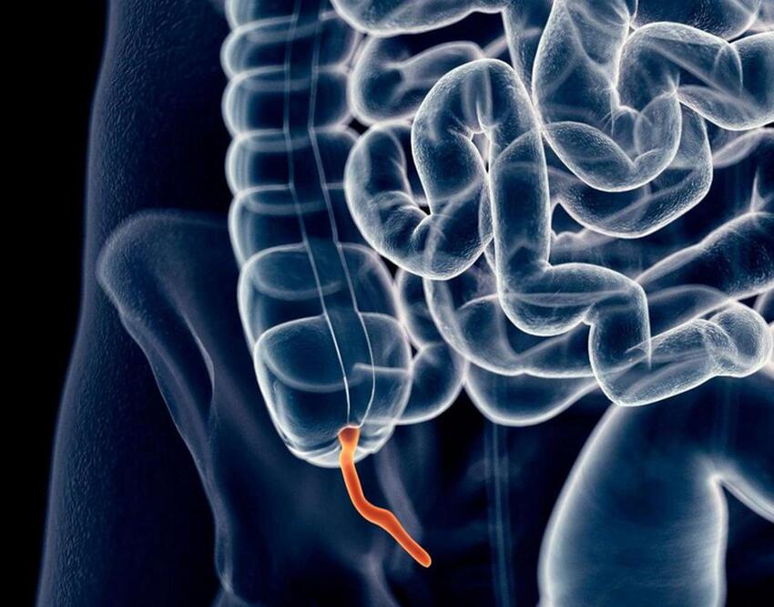 Дальше будет поздно: врач назвал самые ранние симптомы рака кишечника ...