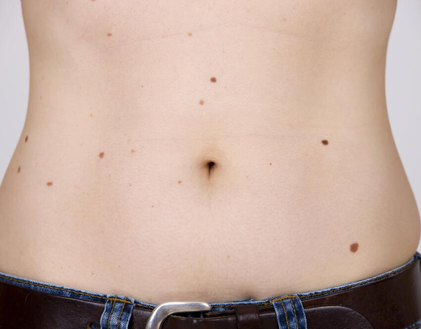 5 признаков опасности: как понять, что у вас появились злокачественные ...